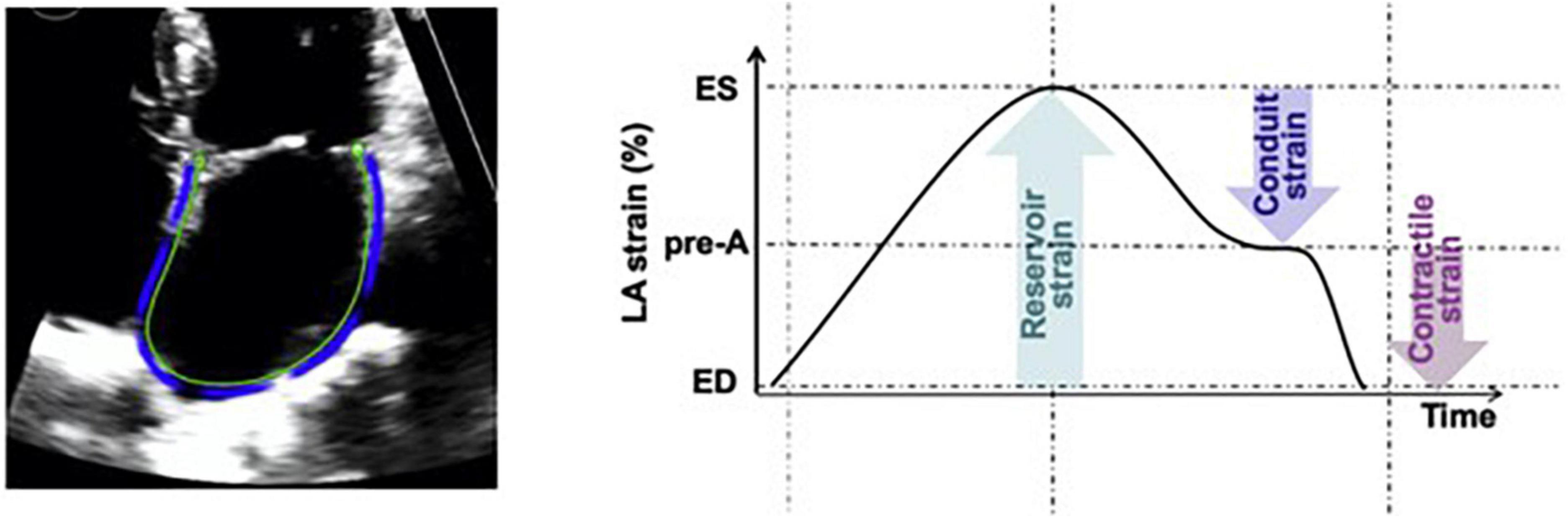 Evaluation of contemporary echocardiographic and histomorphology parameters in predicting mortality in patients with endomyocardial biopsy-proven cardiac AL amyloidosis